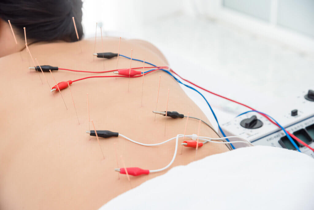 Electro Needling